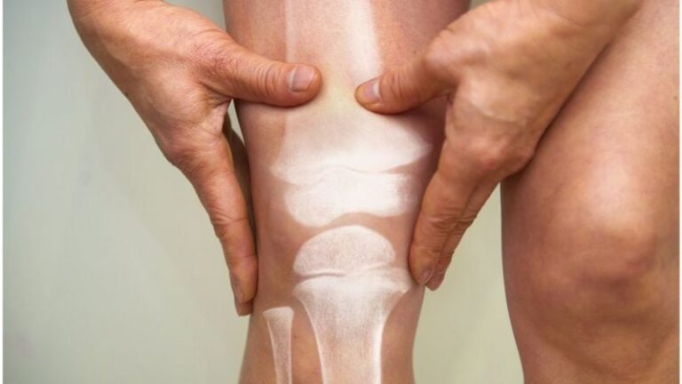 Los 6 antiinflamatorios naturales que puede usar para terminar con el dolor de rodilla